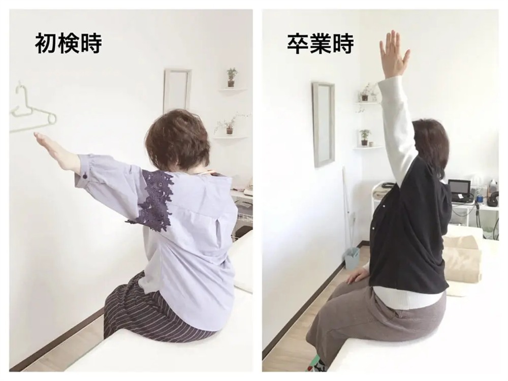 五十肩の初検時と卒業時の比較写真。初検時は腕が100°位しか上がらない状態から、卒業時には垂直まで真っ直ぐ腕が上がるよう改善された50代の患者様の様子