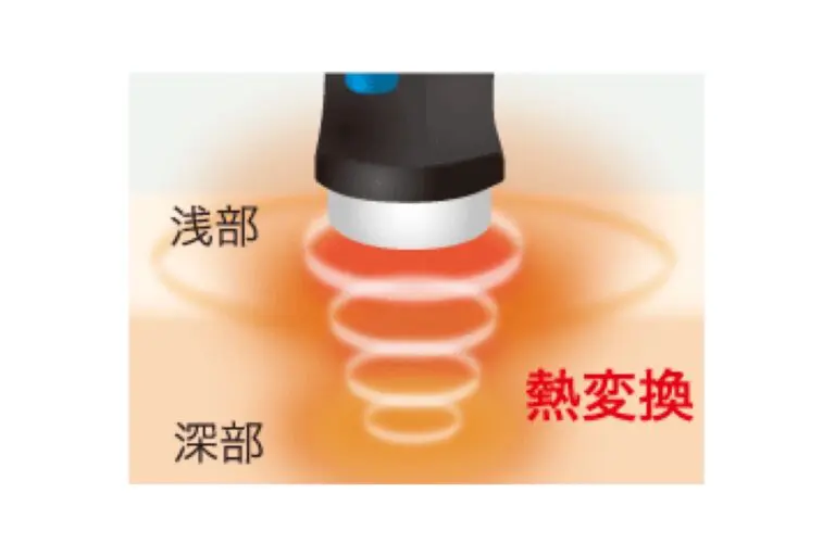 超音波治療器の導子を肌に当て、超音波が体の浅い部分から深い部分へ伝わって熱に変わる様子を示したイラスト